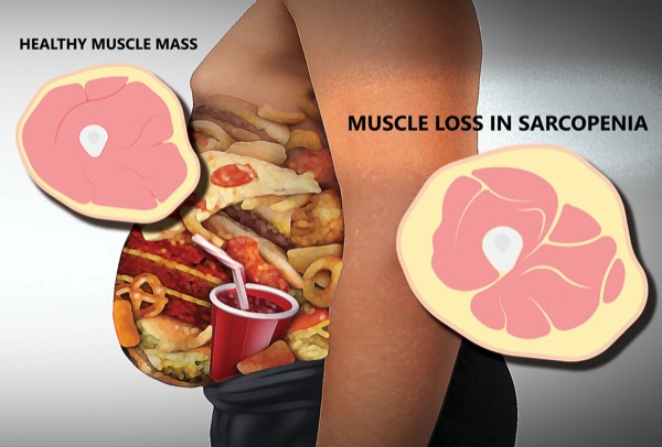 Diagnosing And Understanding Malnutrition Challenges In Patients With