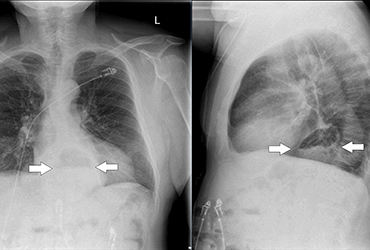 Simple Test Can Reveal More Hiatal Hernias