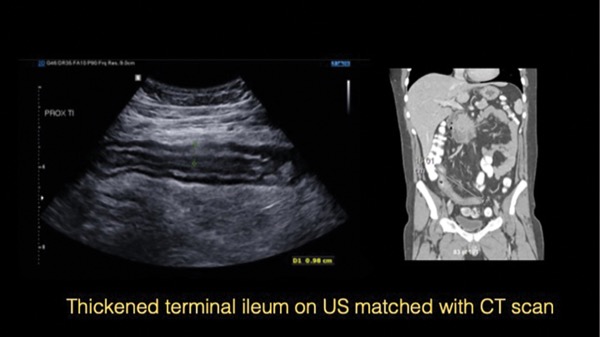 terminal ileum ultrasound