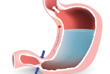 Functional Dyspepsia and Gastroparesis Called Same Disorder