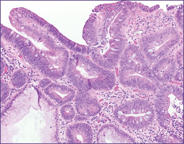 Crypt Dysplasia in Barrett’s Esophagus: An Update - Gastroenterology ...