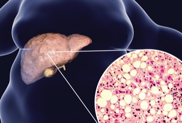 New Point-of-Care Ultrasound Tool May Aid Detection of Liver Stiffness ...