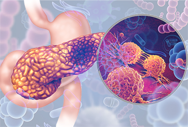 Early Pancreatic Cancer Detection Possible Via Stool Analysis