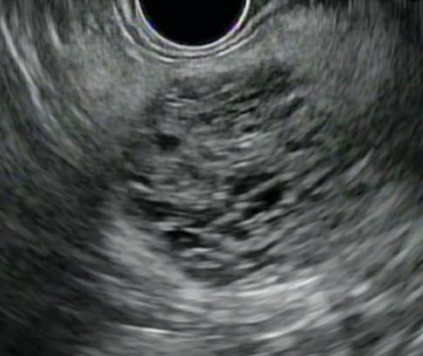 Pancreatic Cystic Lesions: A Case-Based Approach