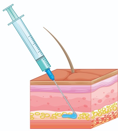 Moving From IV to Subcutaneous Infliximab, and an Updated Look at ...