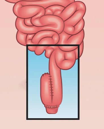 Postoperative Considerations in IBD